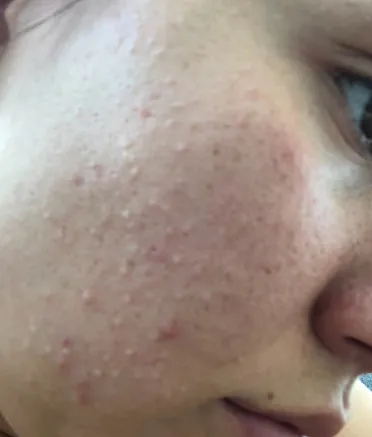 woman cheek with acne